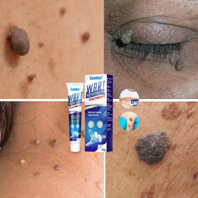 DITES ADIEU AUX VERRUES ET ACCROCHONS EN TOUTE SECURITE ET EN QUELQUES JOURS